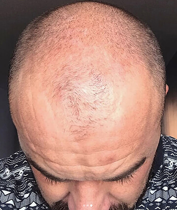 scalp micropigmentation before picture