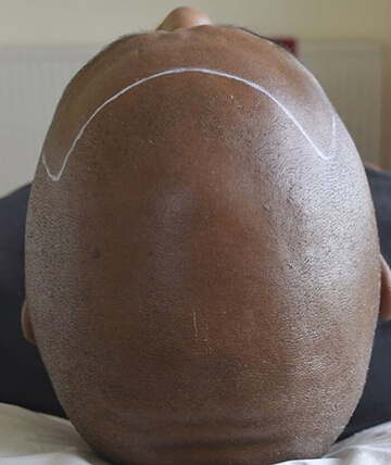scalp micropigmentation before picture